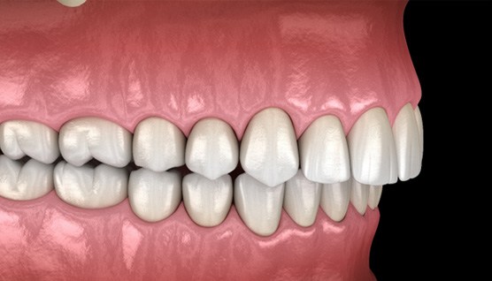 a digital representation of an overbite