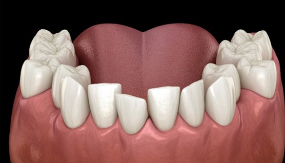 an example of generally crooked teeth
