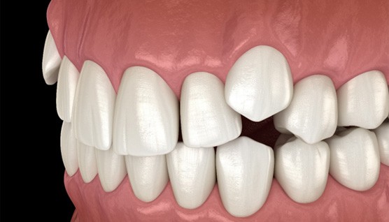 a digital illustration of impacted teeth