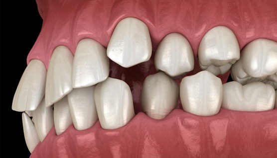  an example of overcrowded teeth