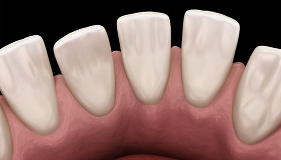  an example of gaps between teeth