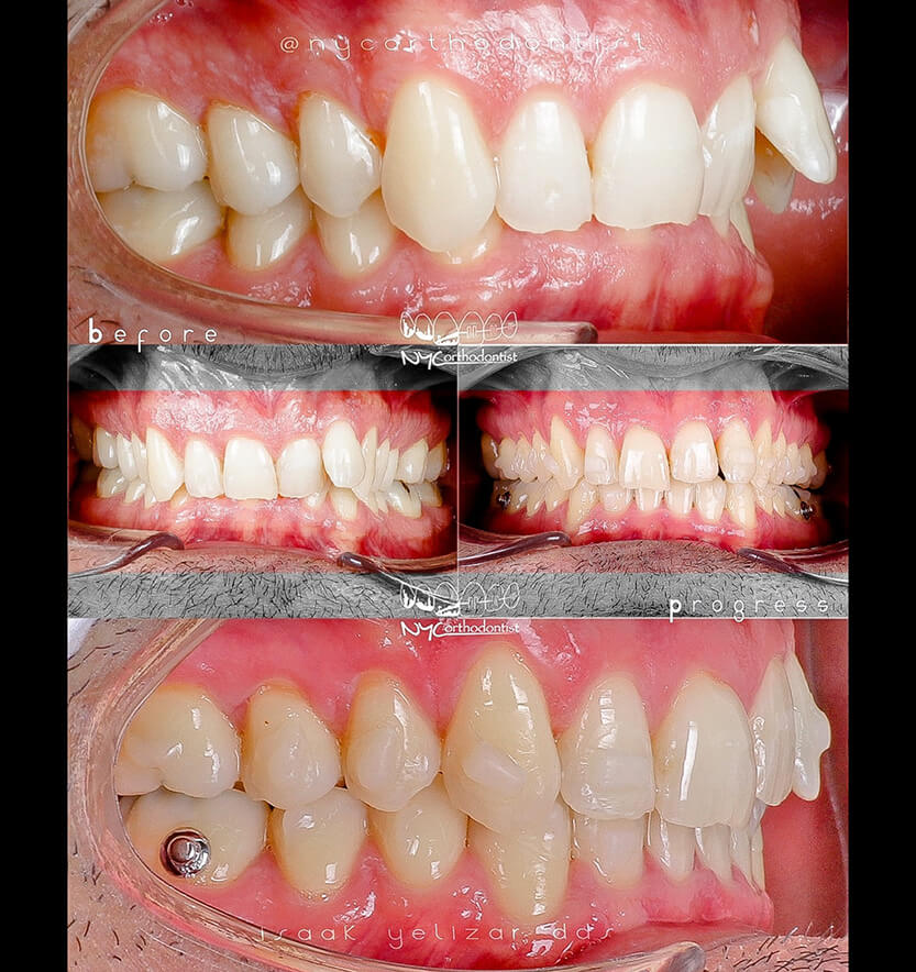 Side and front view of smile before and after orthodontic treatment for crossbite
