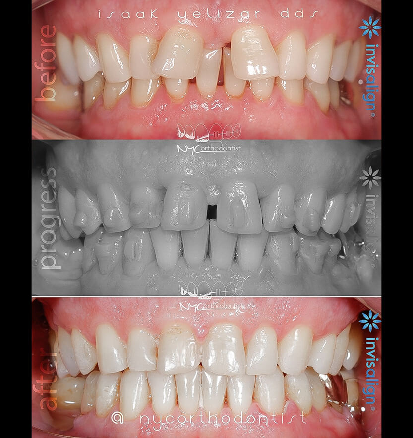 Smile before during and after treatment for overbite