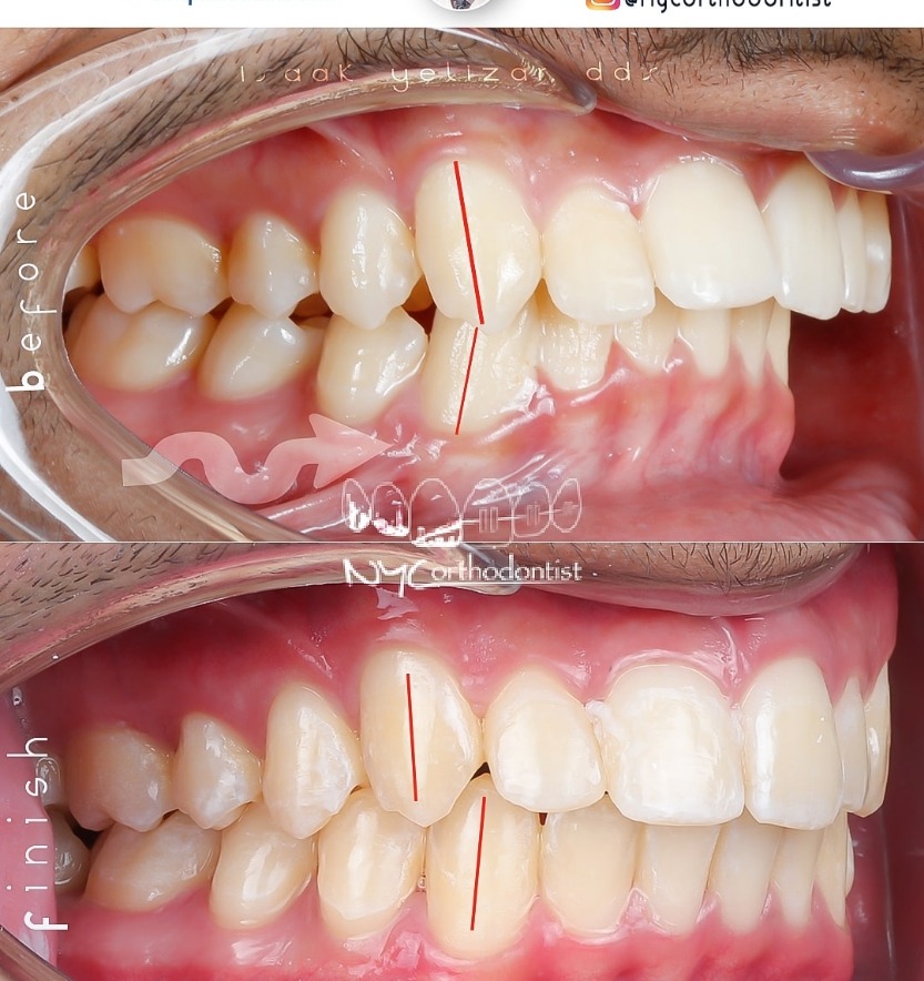 Side view of smile before and after treatment for overbite