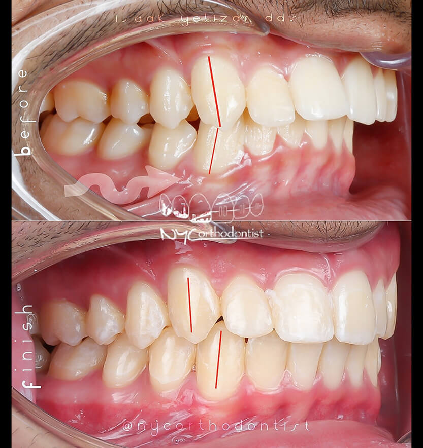 Side view of smile before and after treatment for overbite