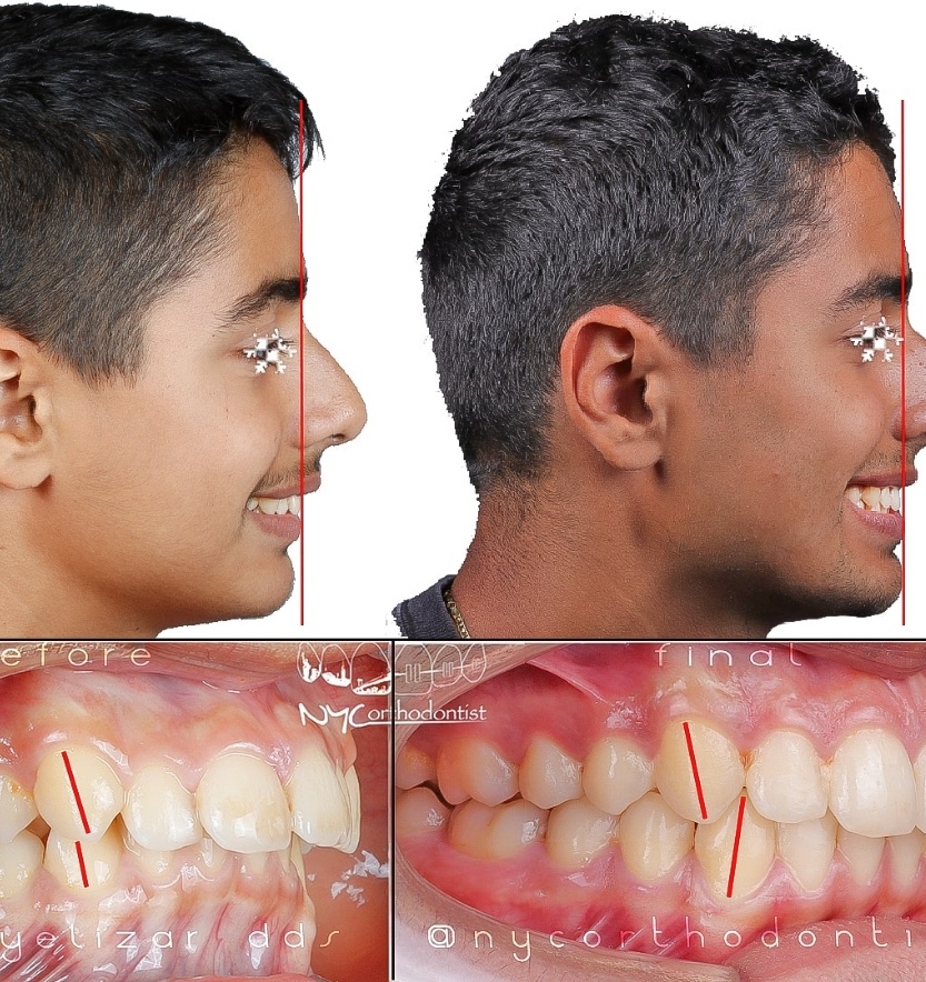 Patient's profile and closeup of side of smile before and after treatment for overbite
