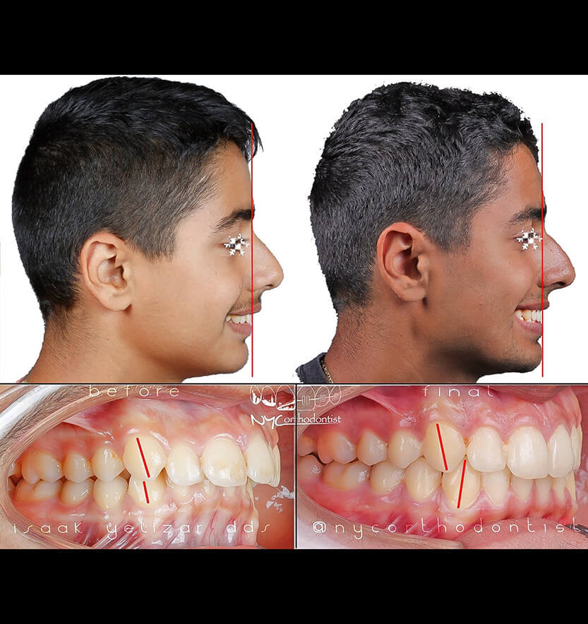Smile before and after incognito orthodontic treatment for class two bite alignment issues