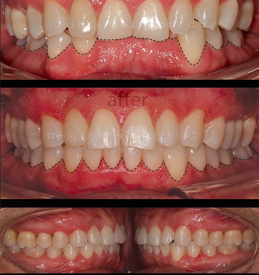 Front and side view of smile before and after orthodontic treatment for overbite
