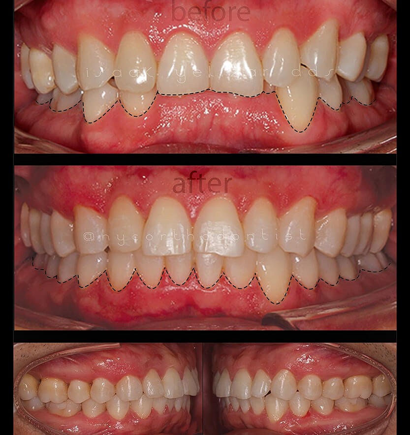 Front and side view of smile before and after orthodontic treatment for overbite