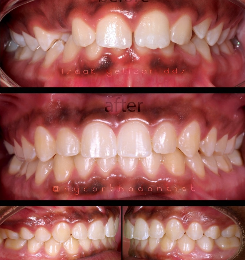 Closeup of front and side view of smile before and after treatment for overbite