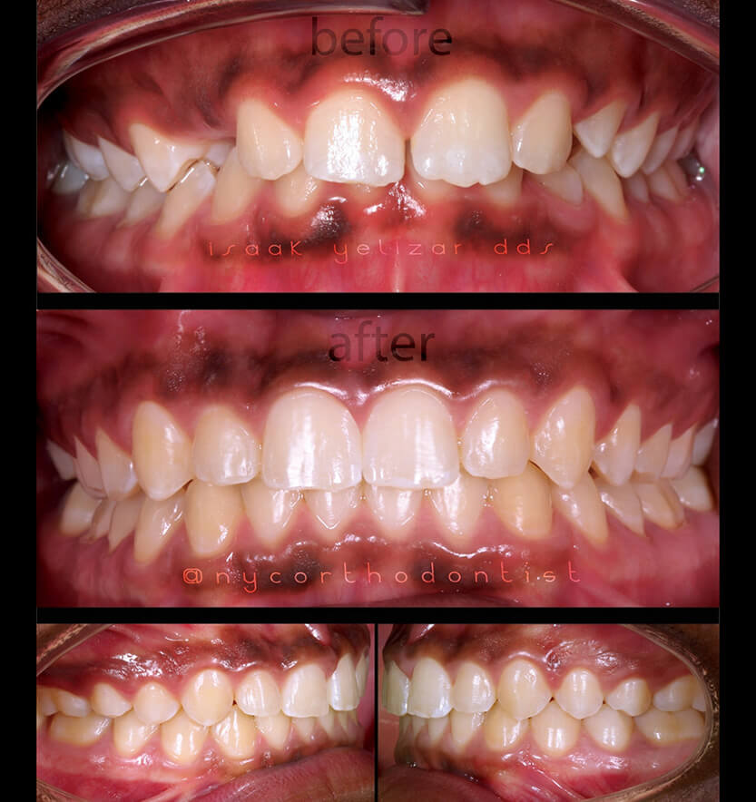 Closeup of front and side view of smile before and after treatment for overbite