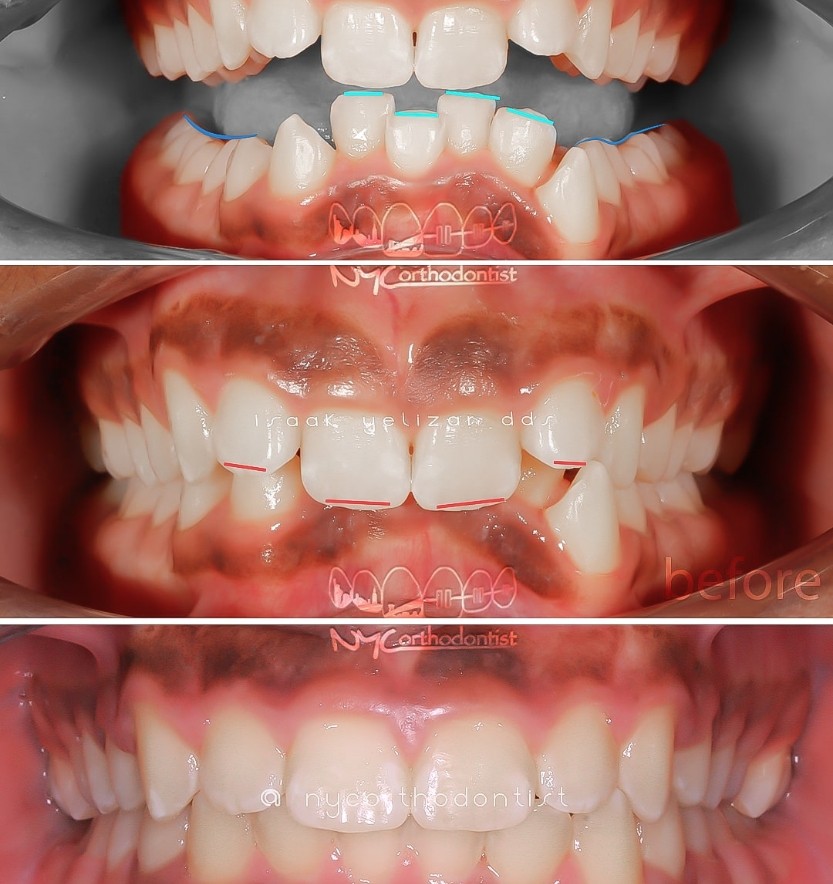Smile before and after orthodontic treatment for severe overbite