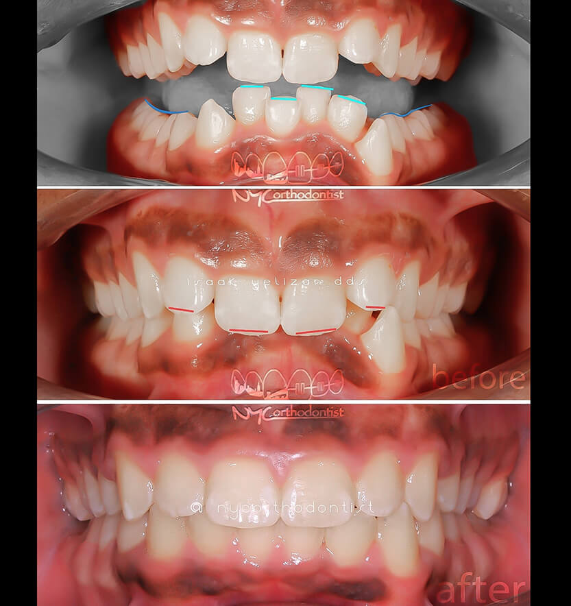 Smile before and after orthodontic treatment for severe overbite