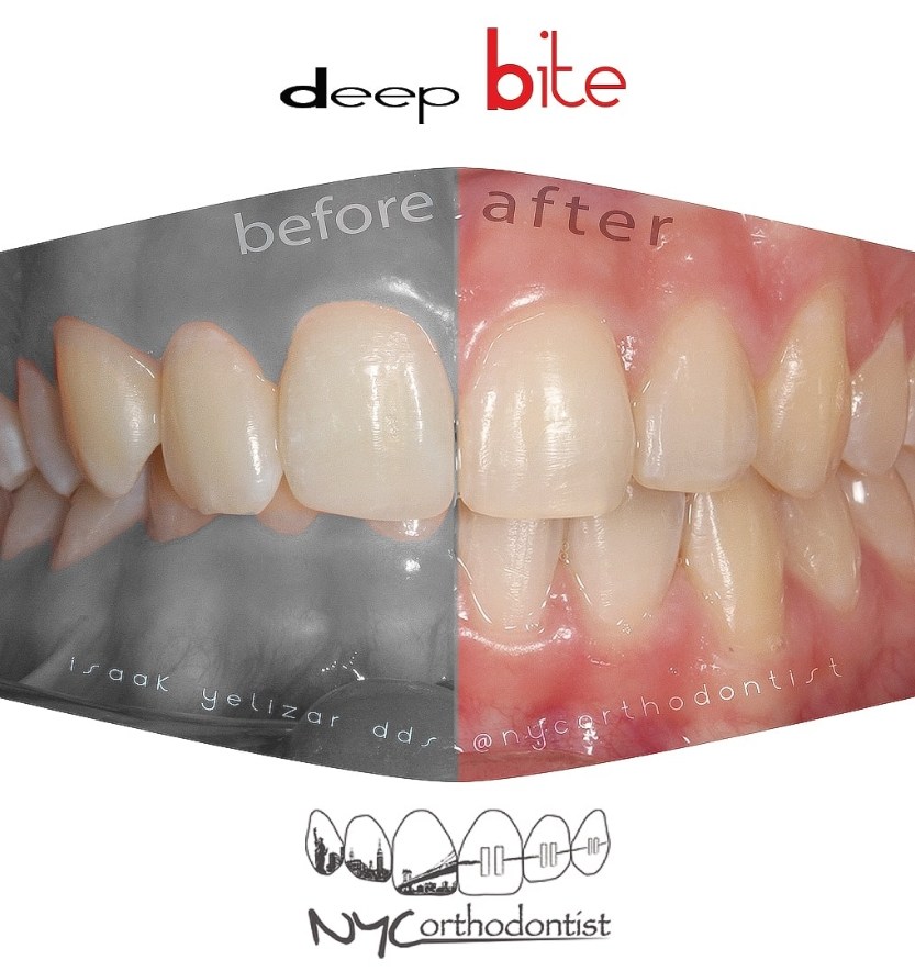 Closeup of smile comparing alignment before and after orthodontic treatment for overbite