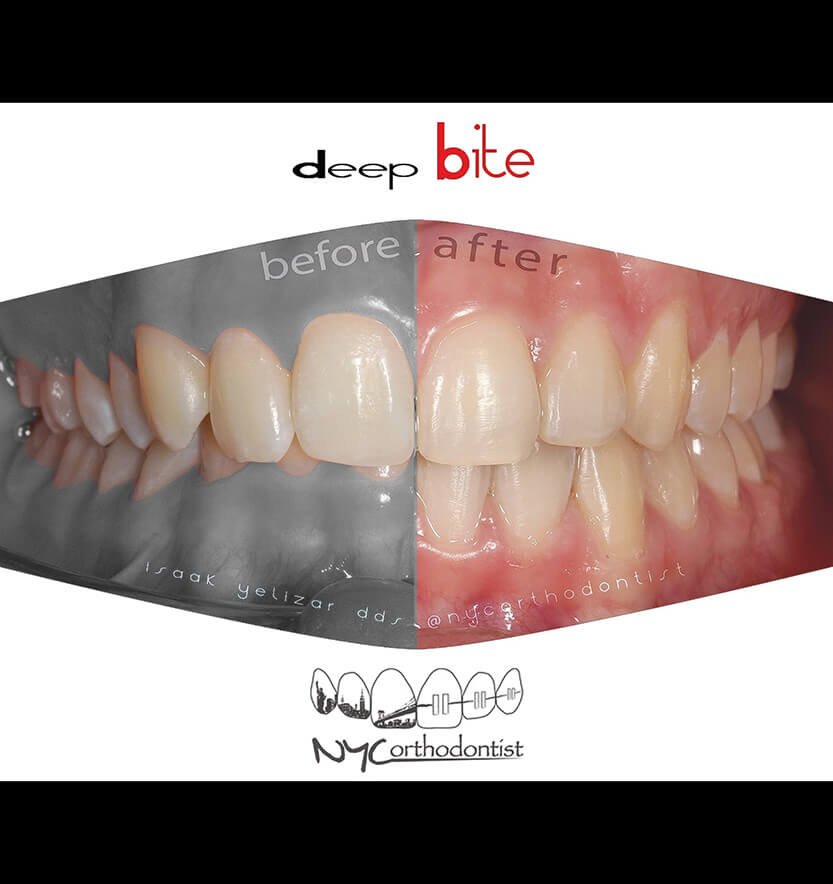 Closeup of smile comparing alignment before and after orthodontic treatment for overbite