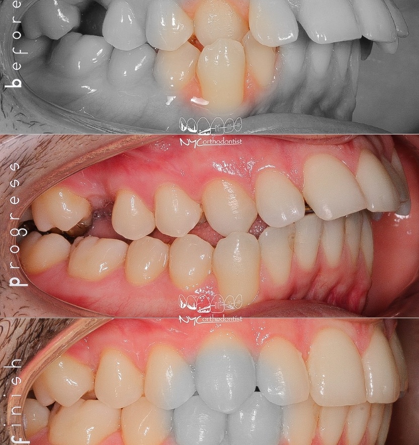 Side view of smile before during and after orthodontic treatment for crossbite