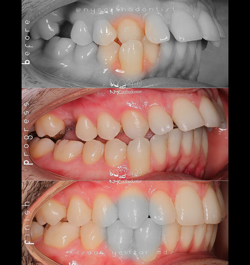 Side view of smile before during and after orthodontic treatment for crossbite