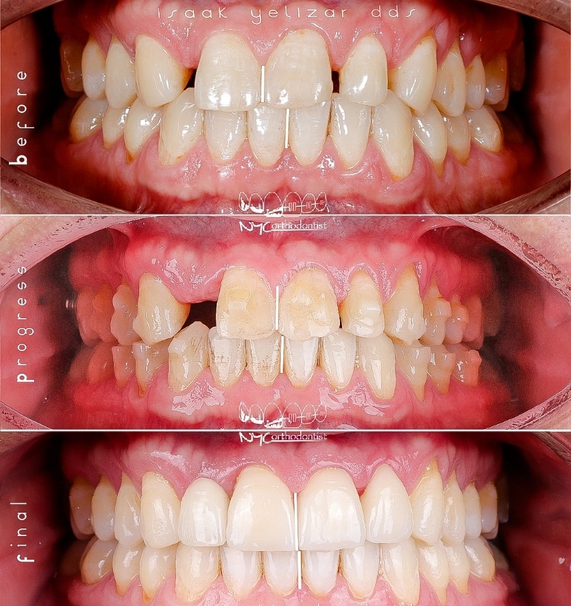 Smile before during and after treatment for pegged teeth