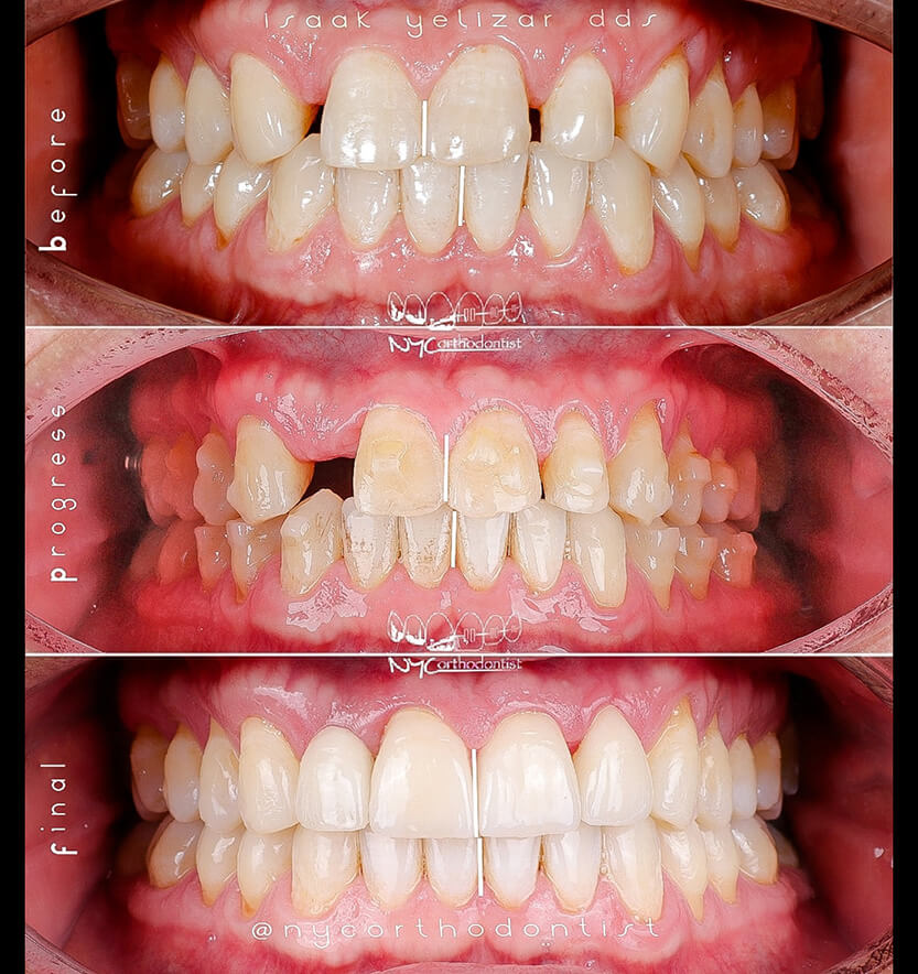 Smile before during and after treatment for pegged teeth