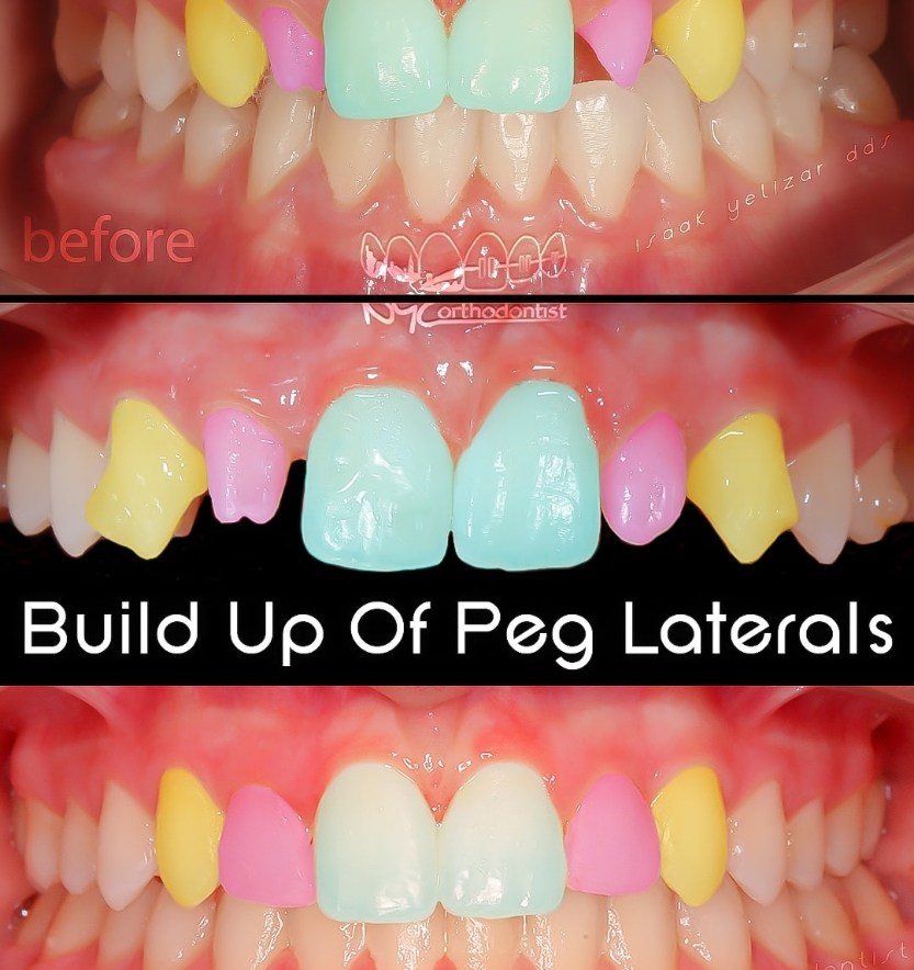 Inside of teeth and front of smile before during and after pegged tooth treatment
