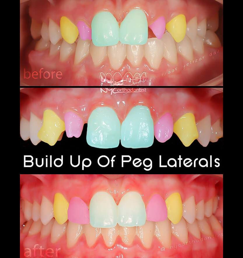 Inside of teeth and front of smile before during and after pegged tooth treatment
