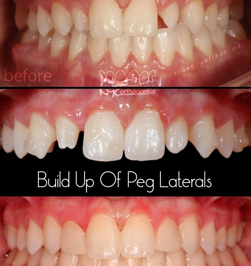 Smile before during and after build up of pegged lateral teeth