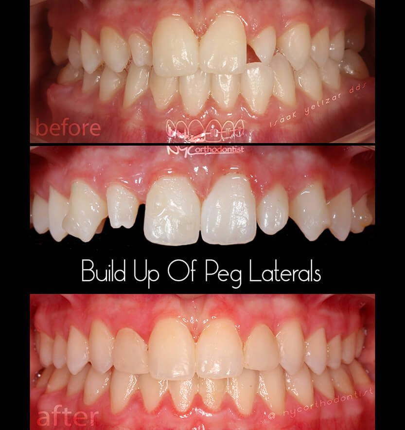 Smile before during and after build up of pegged lateral teeth