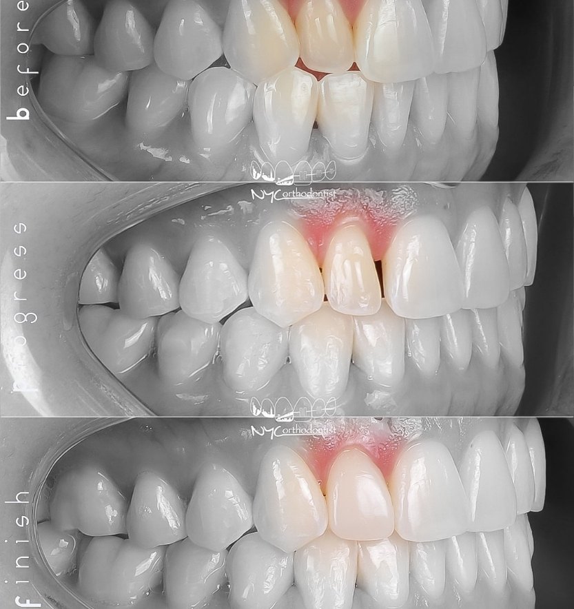 Closeup of smil before during and after pegged tooth treatment
