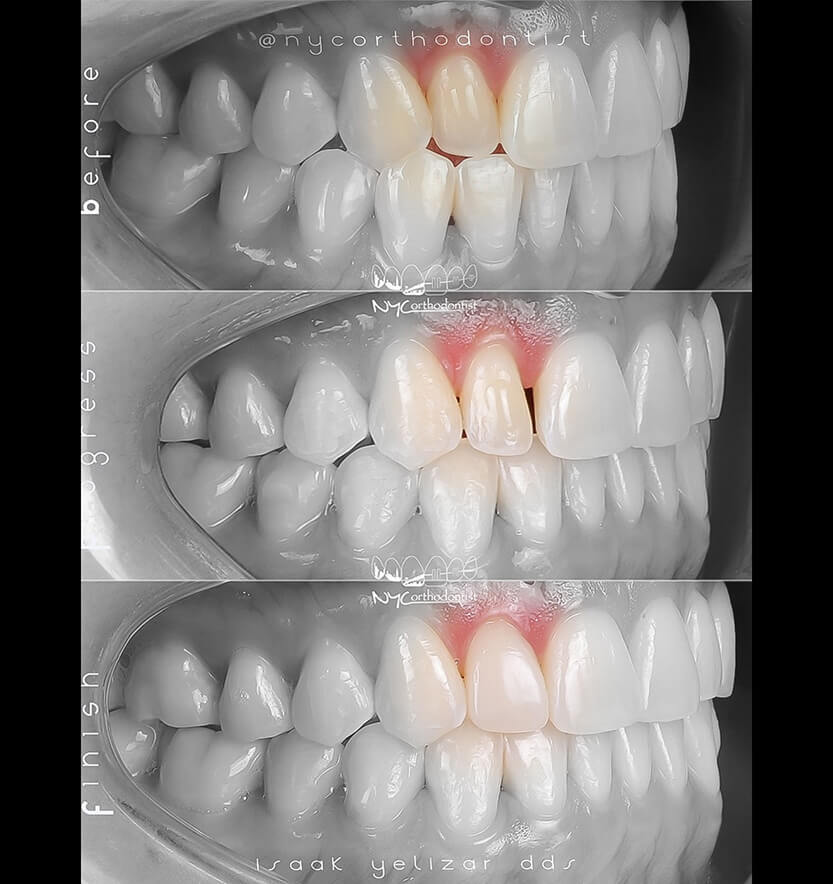 Closeup of smil before during and after pegged tooth treatment