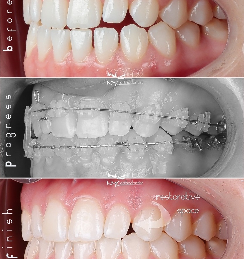Side view of smile before during and after pegged tooth treatment