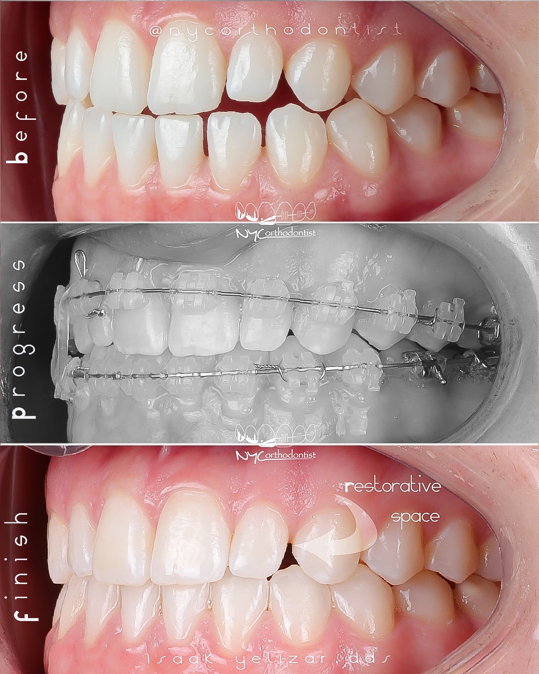 Profile view of smile before during and after pegged tooth treatment