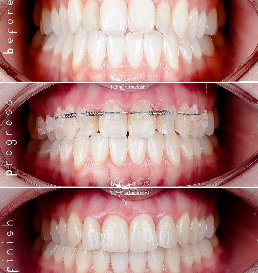 Closeup of smiel before during and after treatment for pegged teeth