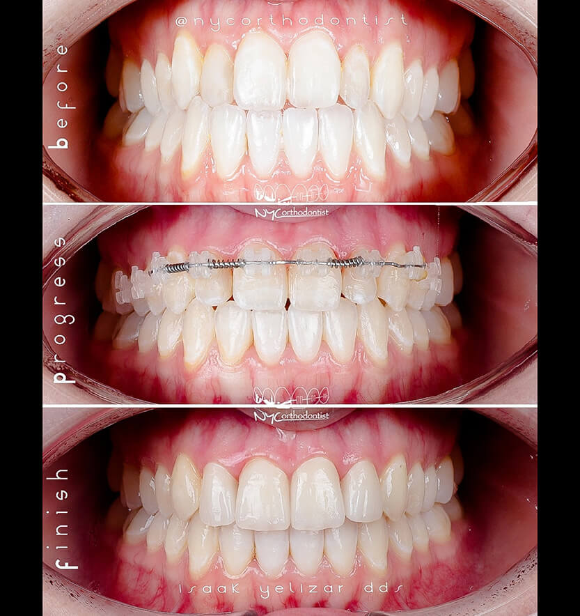 Closeup of smiel before during and after treatment for pegged teeth