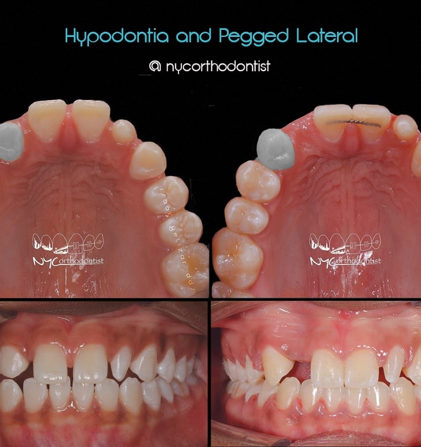 Inside bottom and front of teeth before and after treatment for pegged teeth