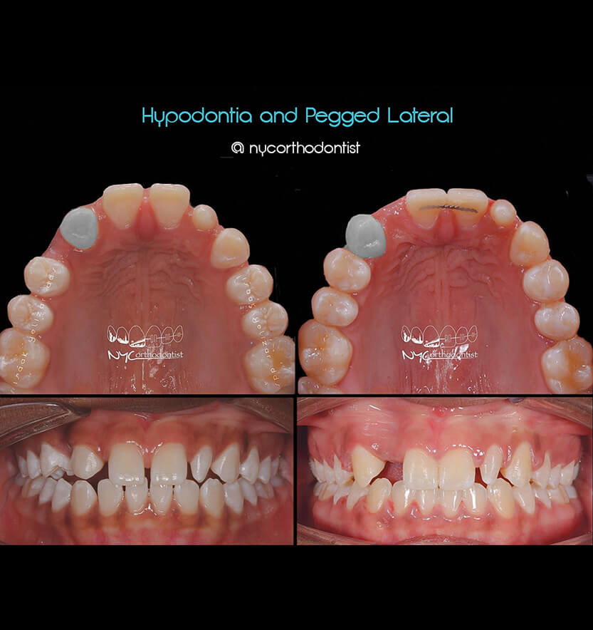 Inside bottom and front of teeth before and after treatment for pegged teeth