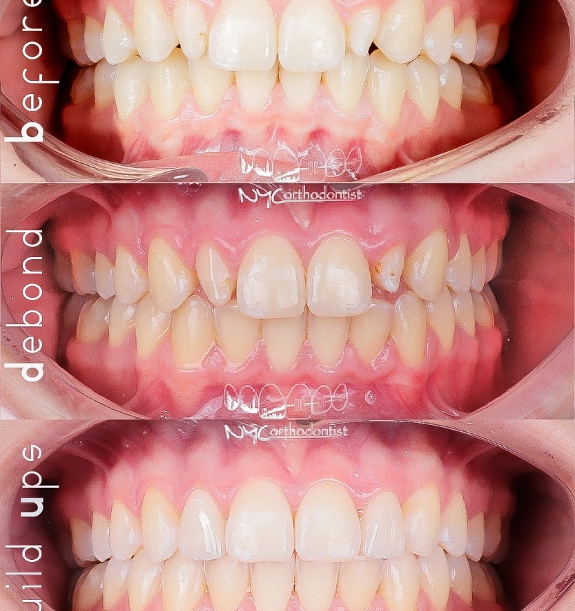 Front of smile before and after treatment for pegged teeth