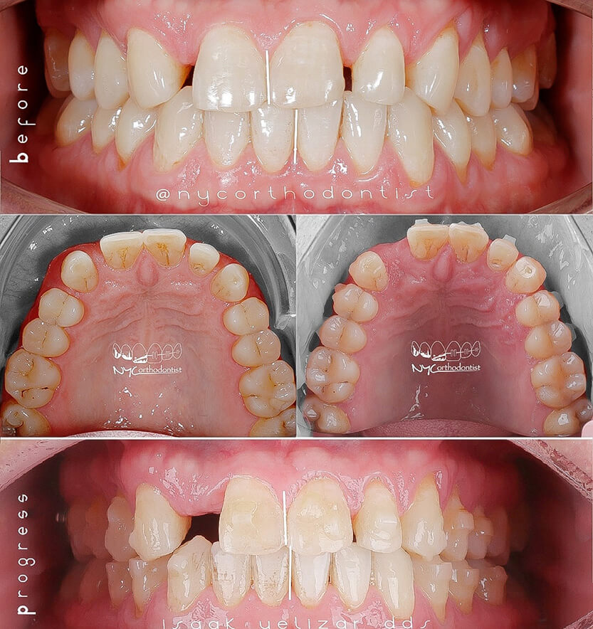 Patient's smiel before during and after treatment for pegged teeth