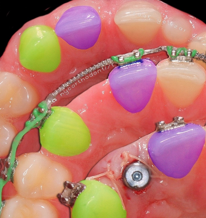 Smile at multiple stages of treatment for pegged teeth