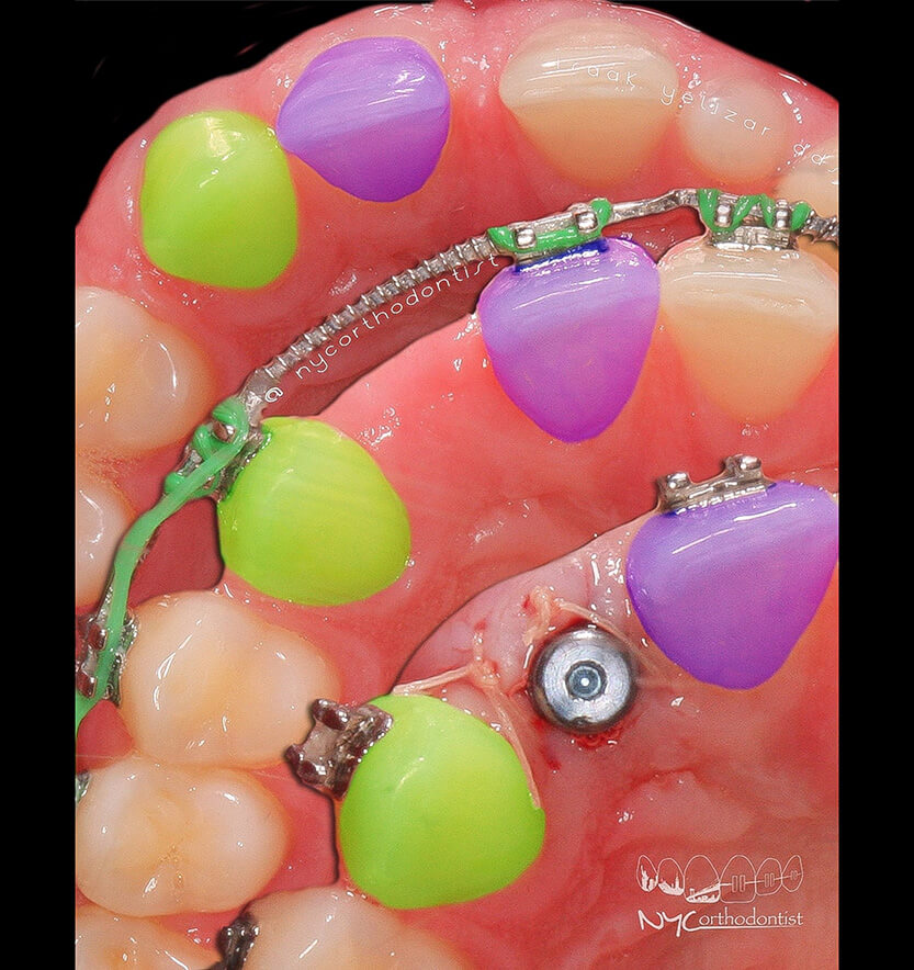 Smile at multiple stages of treatment for pegged teeth