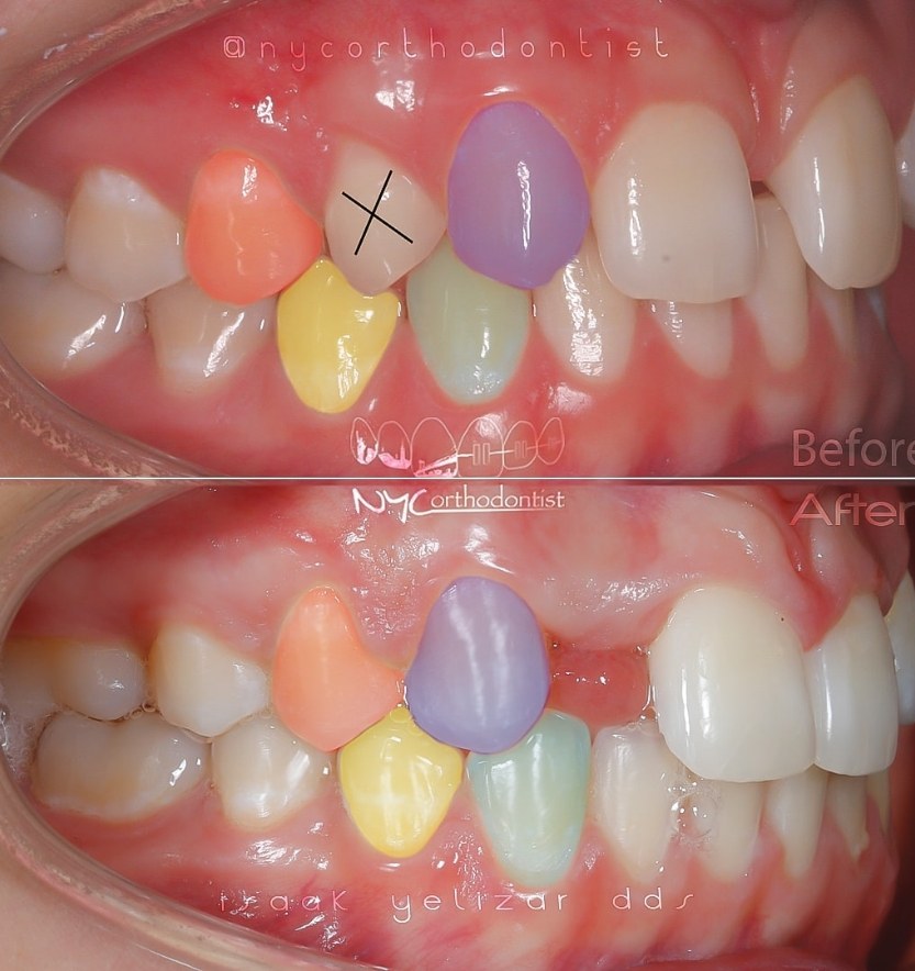 Smile at three stages of treatment for pegged teeth