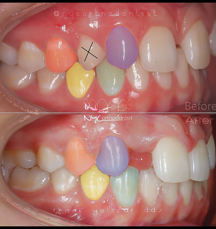Smile at three stages of treatment for pegged teeth