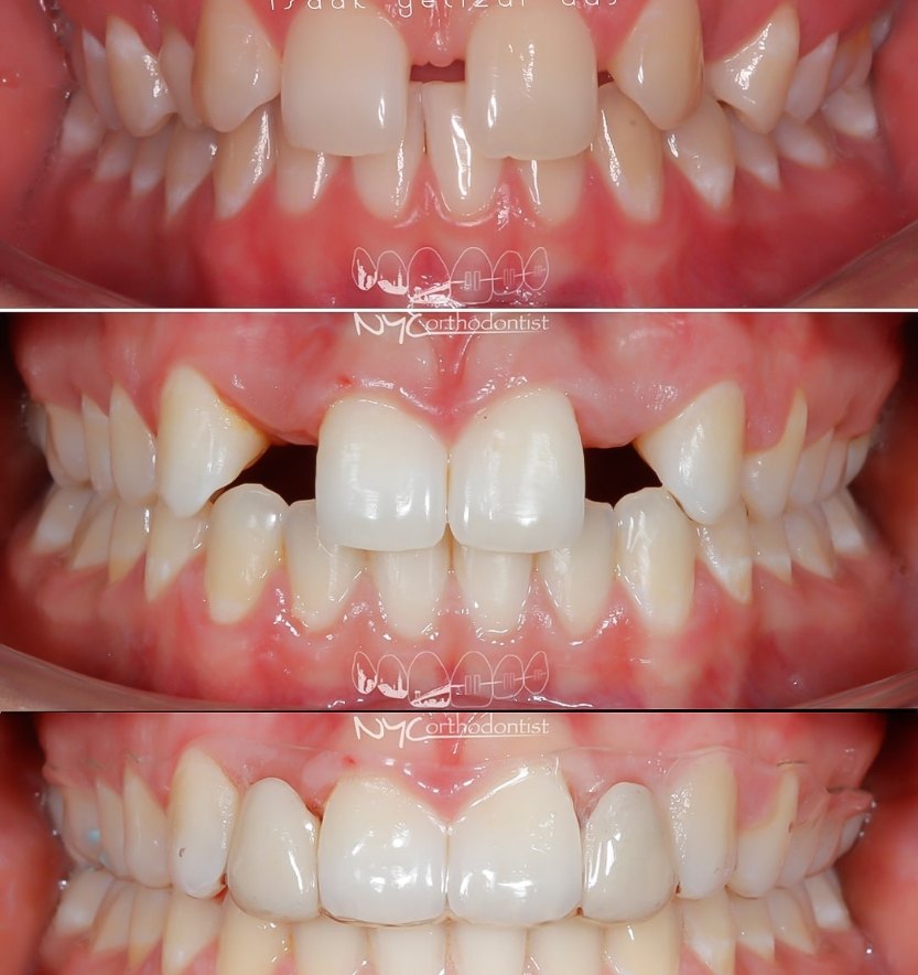 Smile before and after pegged tooth treatment