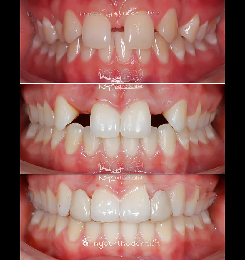 Smile before and after pegged tooth treatment