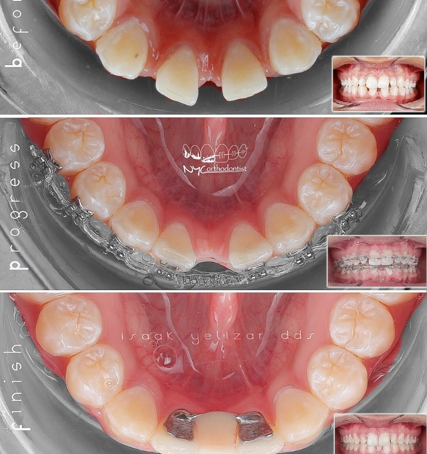 Smile before during and after pegged tooth treatment