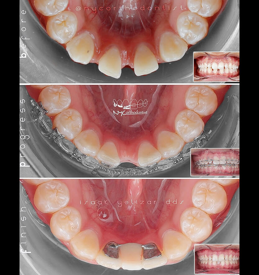 Smile before during and after pegged tooth treatment