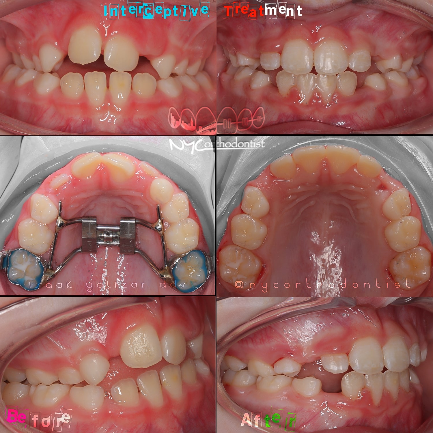Front and profile view of smile and inside bottom teeth before and after phase one orthodontics