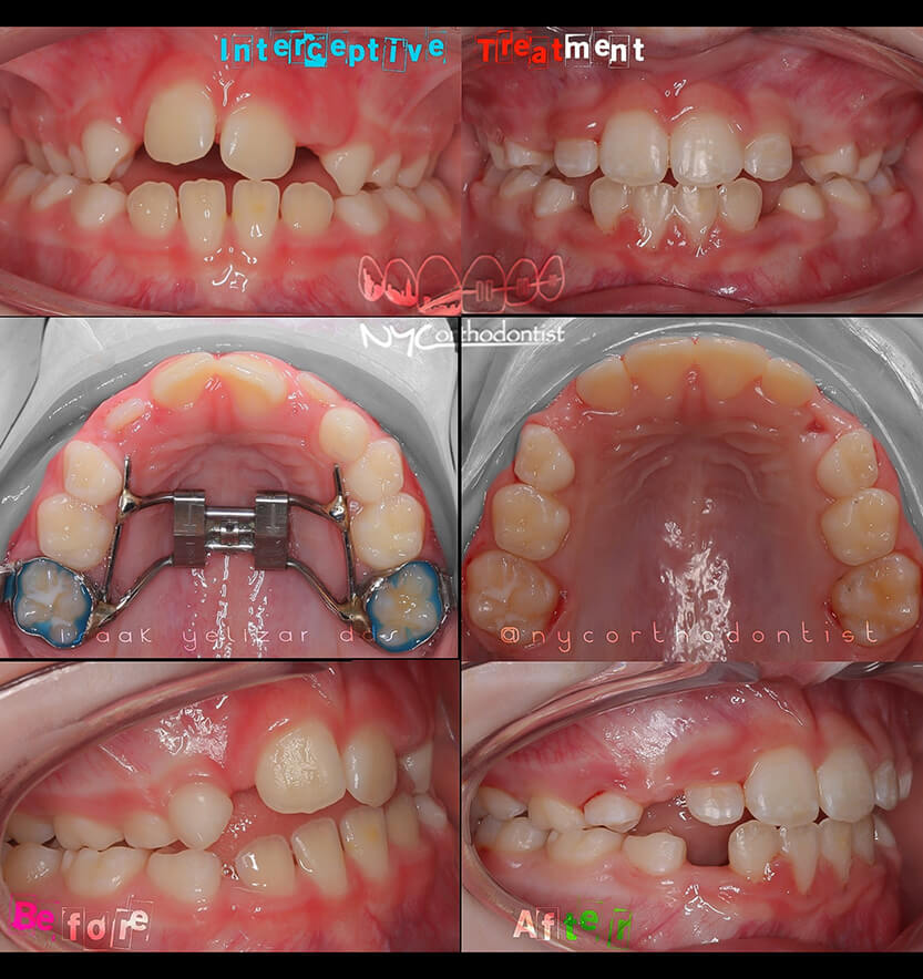 Front and profile view of smile and inside bottom teeth before and after phase one orthodontics