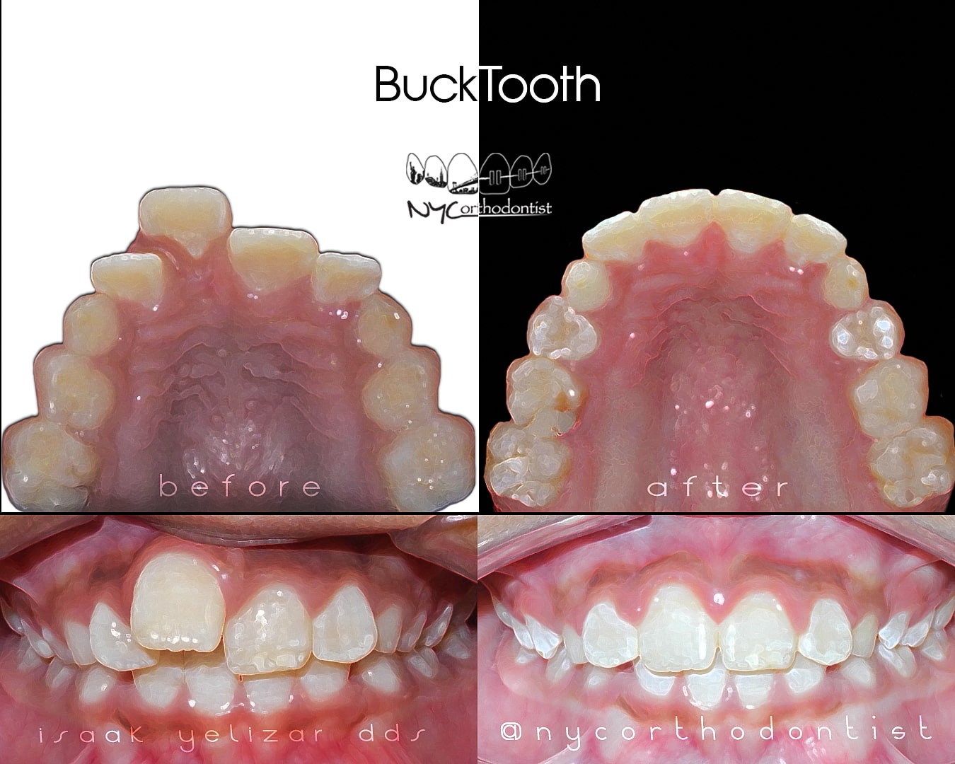 Inside bottom teeth and front of smile before and after phase one orthondontics