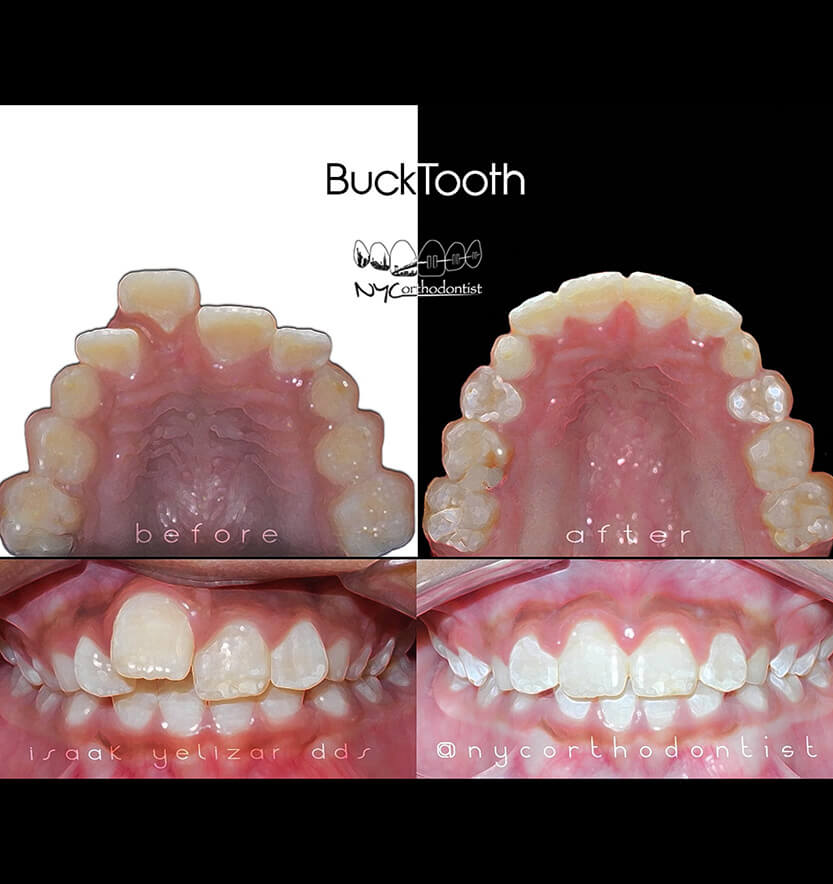 Inside bottom teeth and front of smile before and after phase one orthondontics