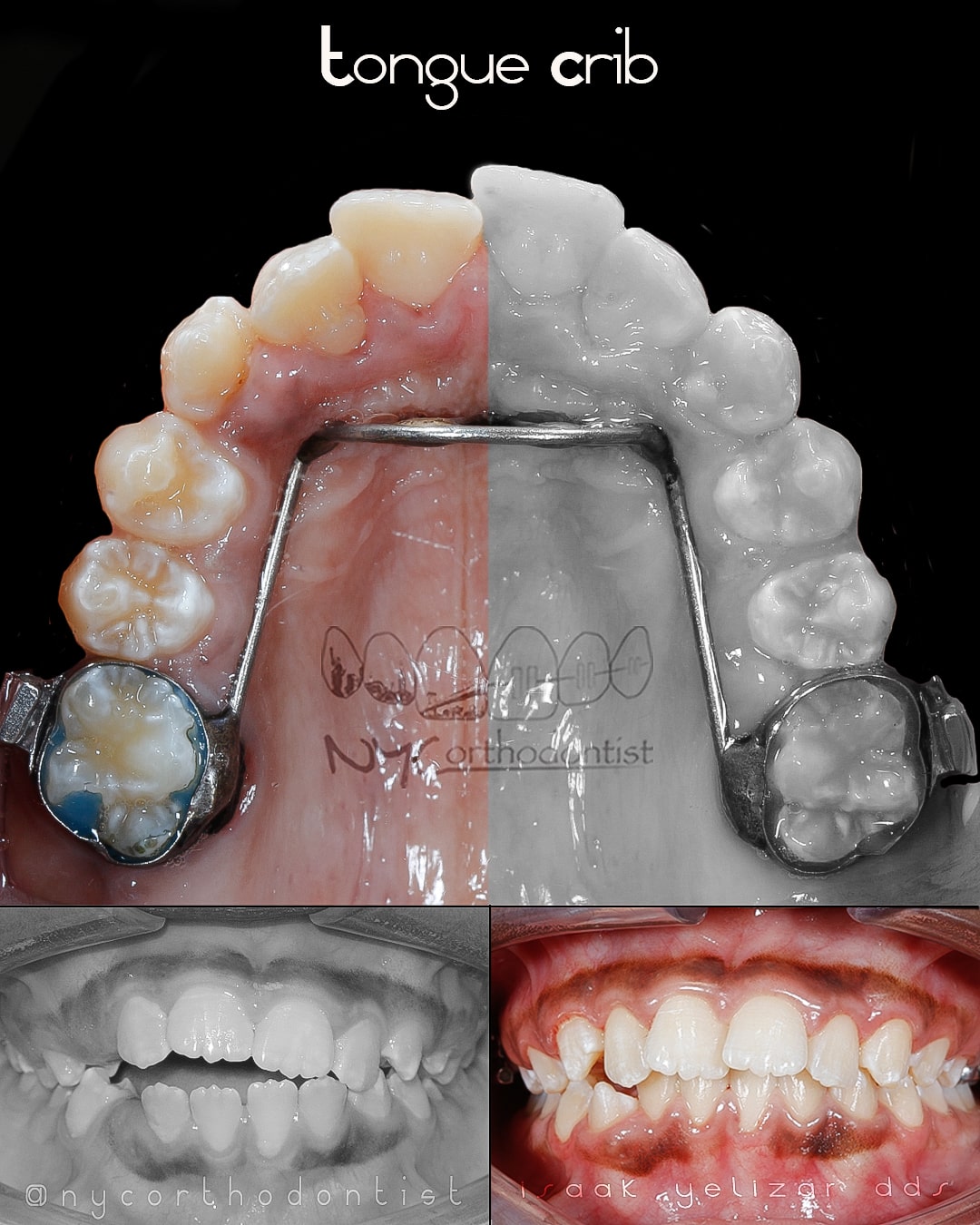Side by side comparison of smile before and after phase on orthodontics
